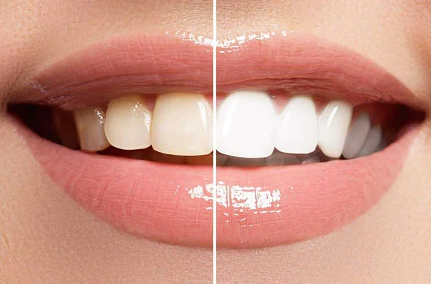 Teeth Whitening