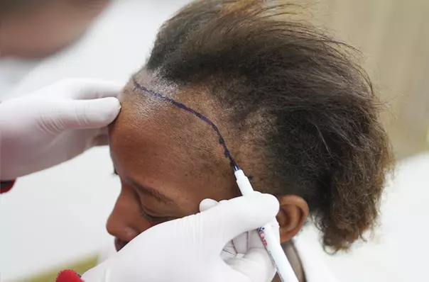 Sapphire Fue Hair Transplant